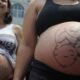 Fatores sociais e estruturais influenciam aumento de cesarianas entre mulheres